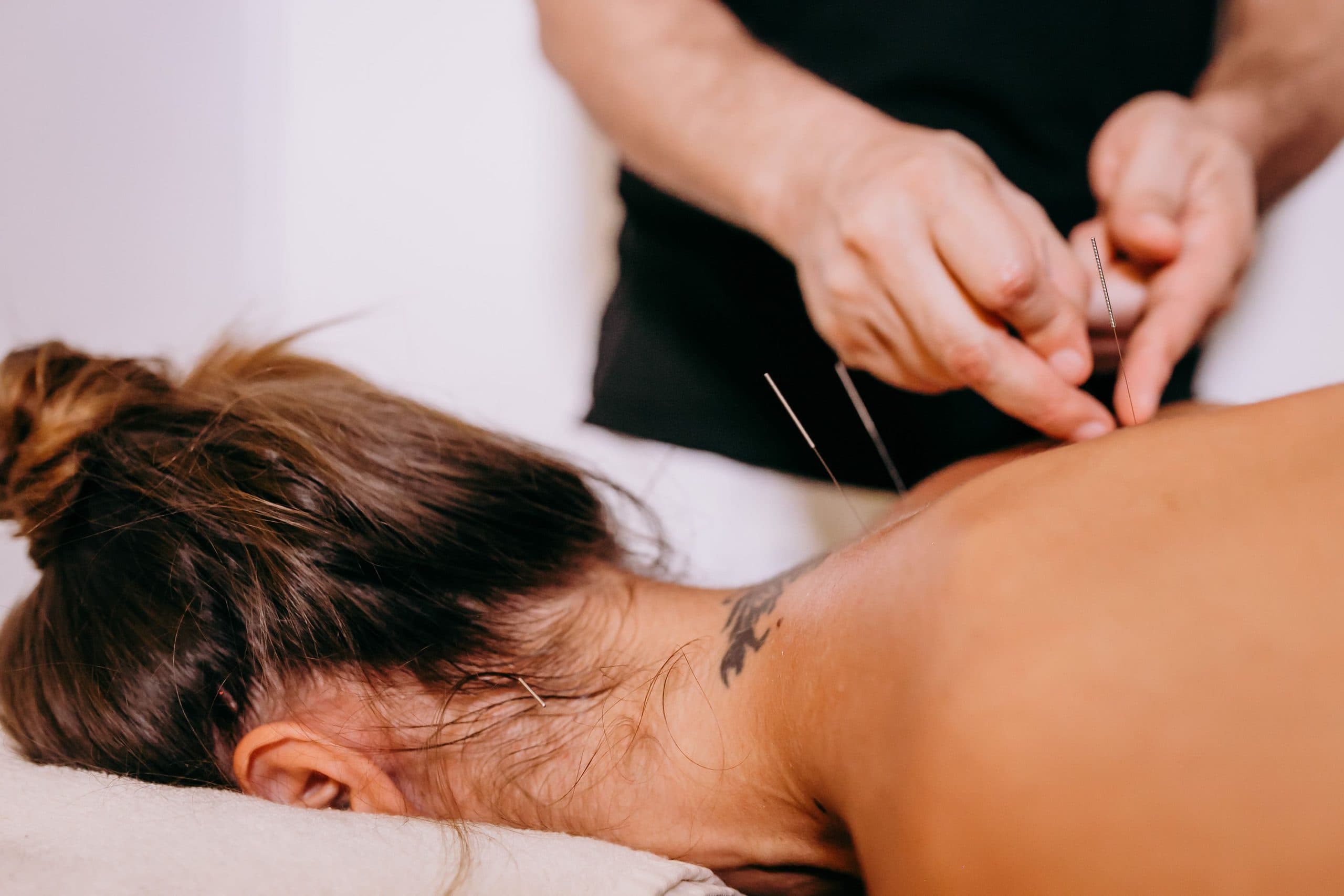 Physiotherapist applying dry needling to a patient's upper back